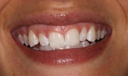 A Before-Veneers-and-Gingivectomy