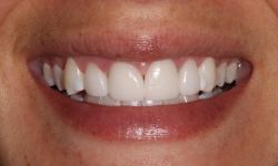 B After-Veneers-and-Gingivectomy