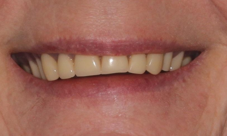 Dentures-Before-Image